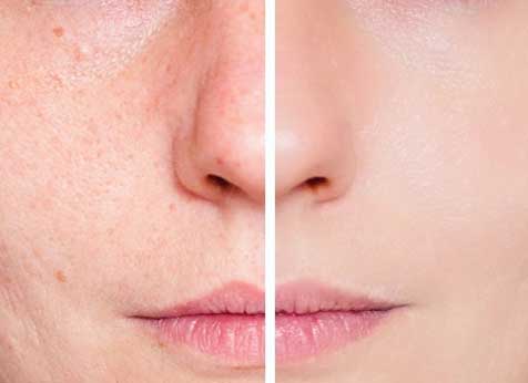 remover manchas de acne